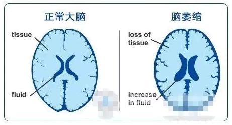 经颅磁治疗|照料老年人脑萎缩患者注意什么 