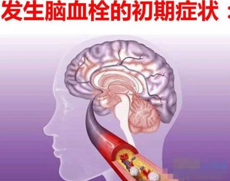 择思达斯经颅磁刺激仪_脑血栓日常注意事项 