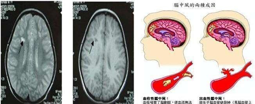 家用的rTMS经颅磁_哪些人容易得脑血栓呢