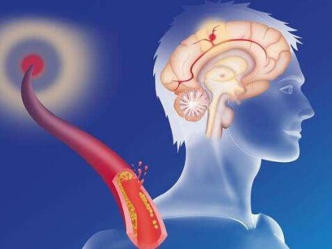 择思达斯经颅超声电疗仪有用吗_脑血栓前兆症状多样 